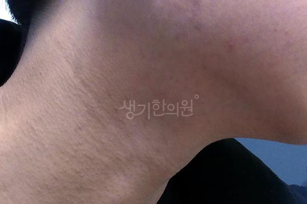 모낭염 치료 후